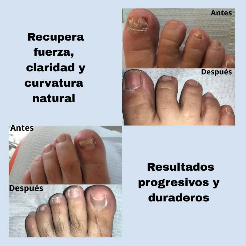 Fungal Nail NightRepair™ – Repara y Fortalece Tus Uñas Mientras Duermes